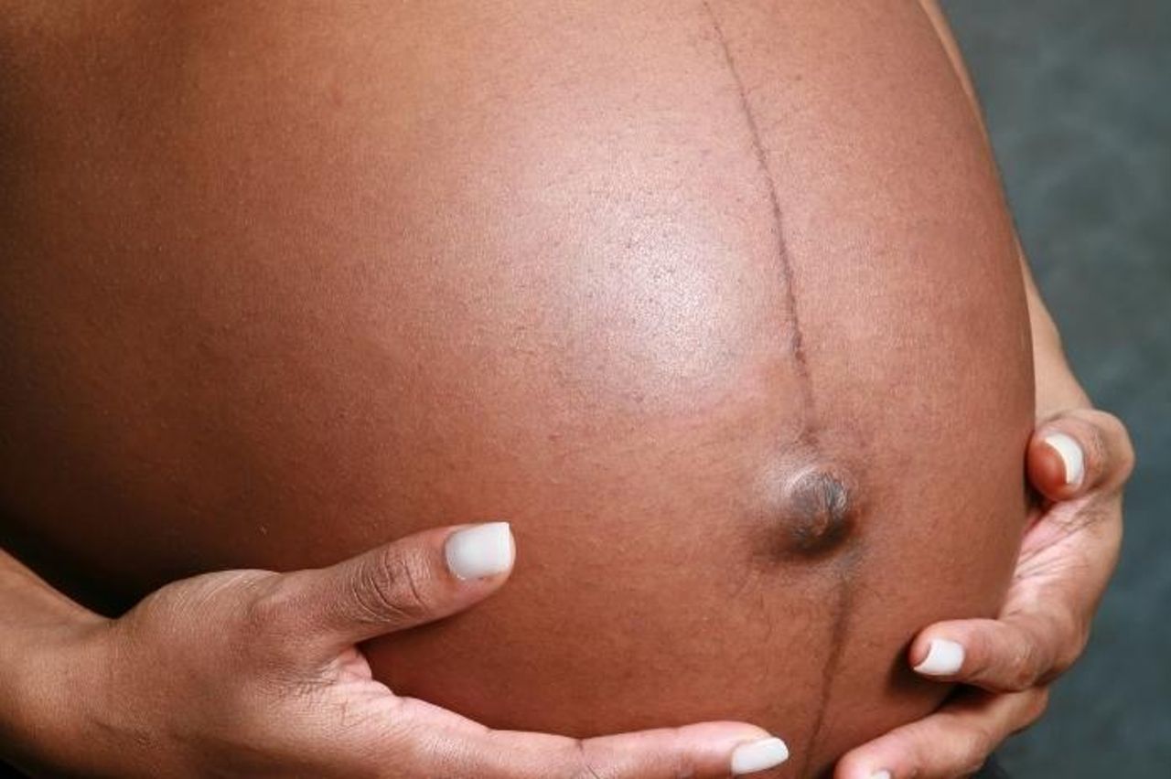 impamvu abagore batwite bazana umurongo w’umukara kugice cy’inda