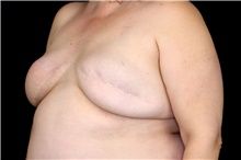 Abagore benshi barimo gusohora amafaranga menshi kugira ngo bongere amabere mu ibanga